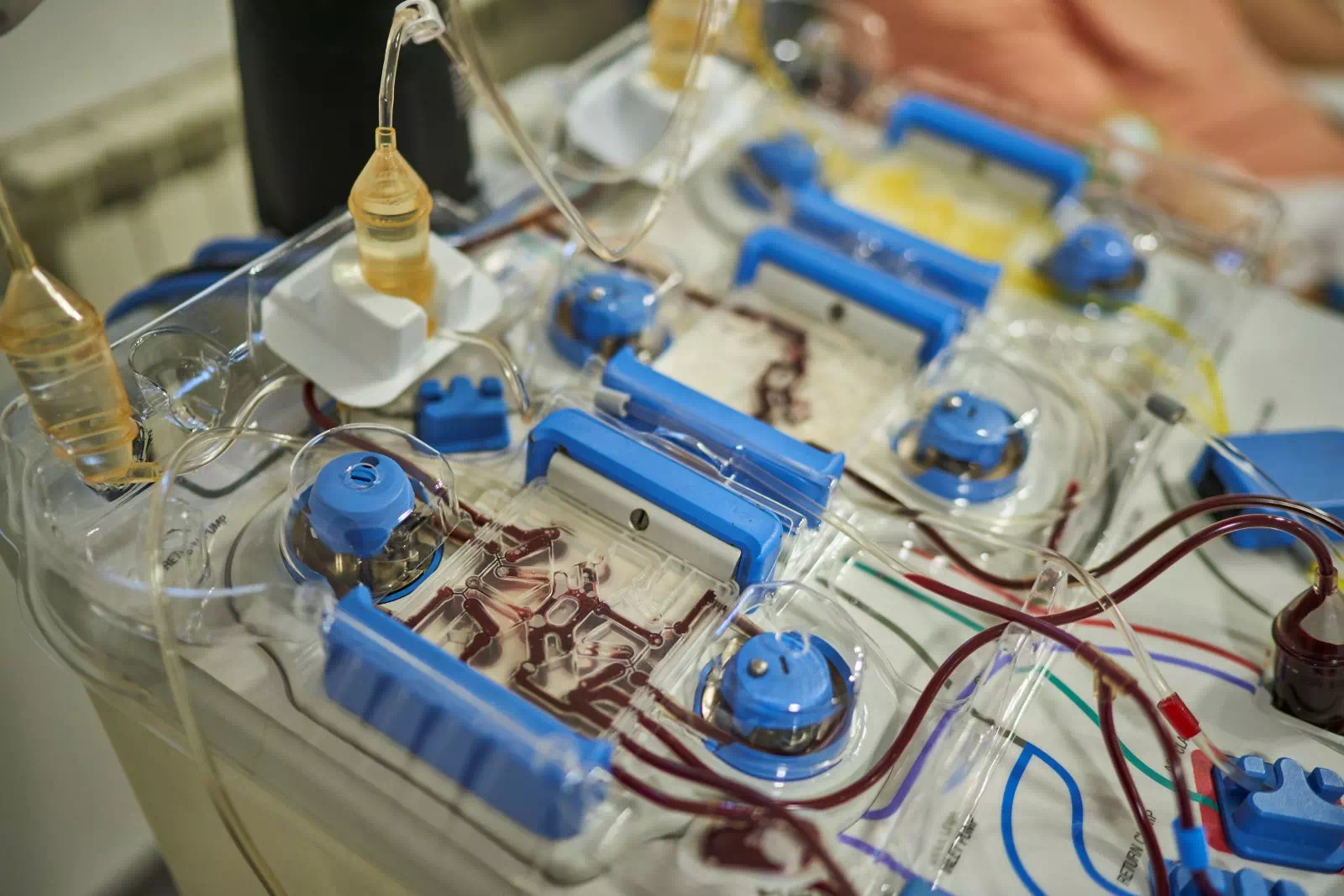Detalj sistema za filtriranje krvi tokom tretmana